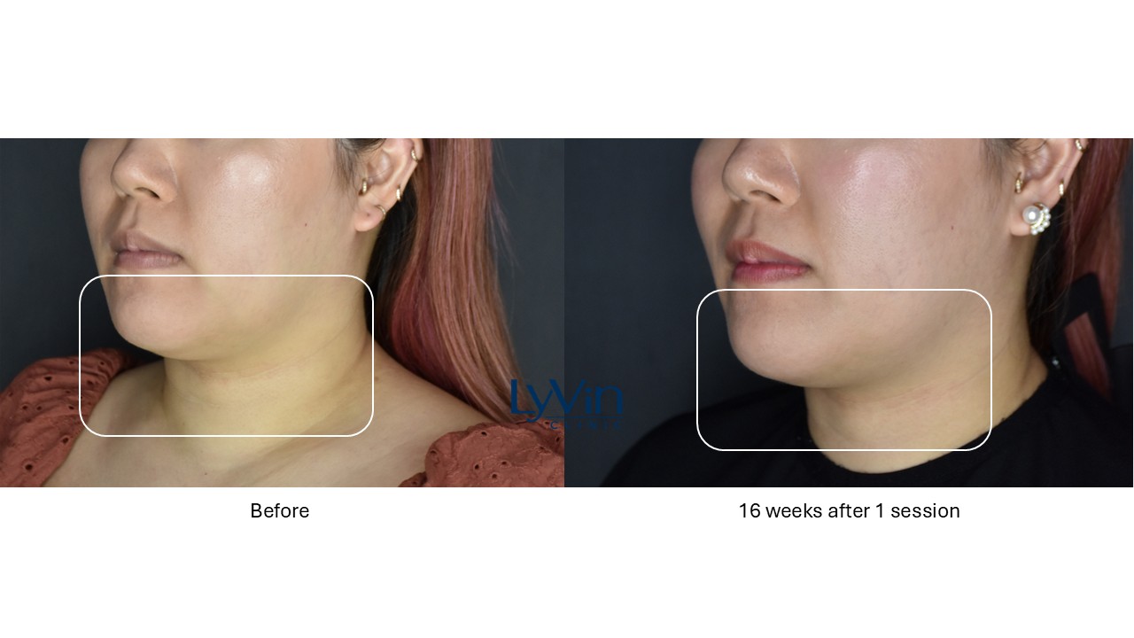 CoolSculpting fat-freezing before and after image for slimmer chin